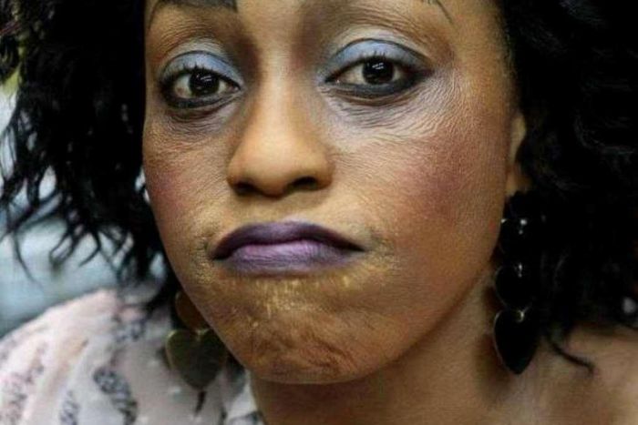 Bleaching has noticeable side effects [modernghana]