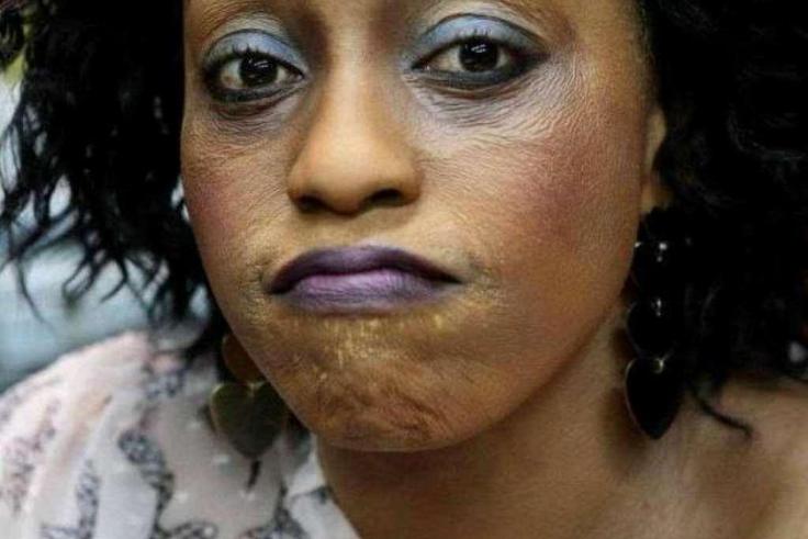 Bleaching has noticeable side effects [modernghana]