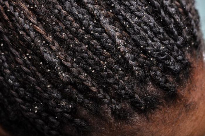 Dandruff can be discomforting [healthline]