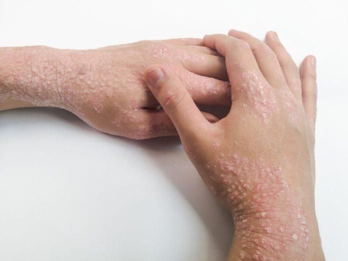 Your skin will react negatively to some bleaching creams [medicunis]