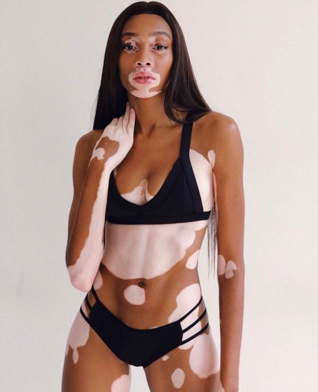Canadian model has vitiligo [Vogue]