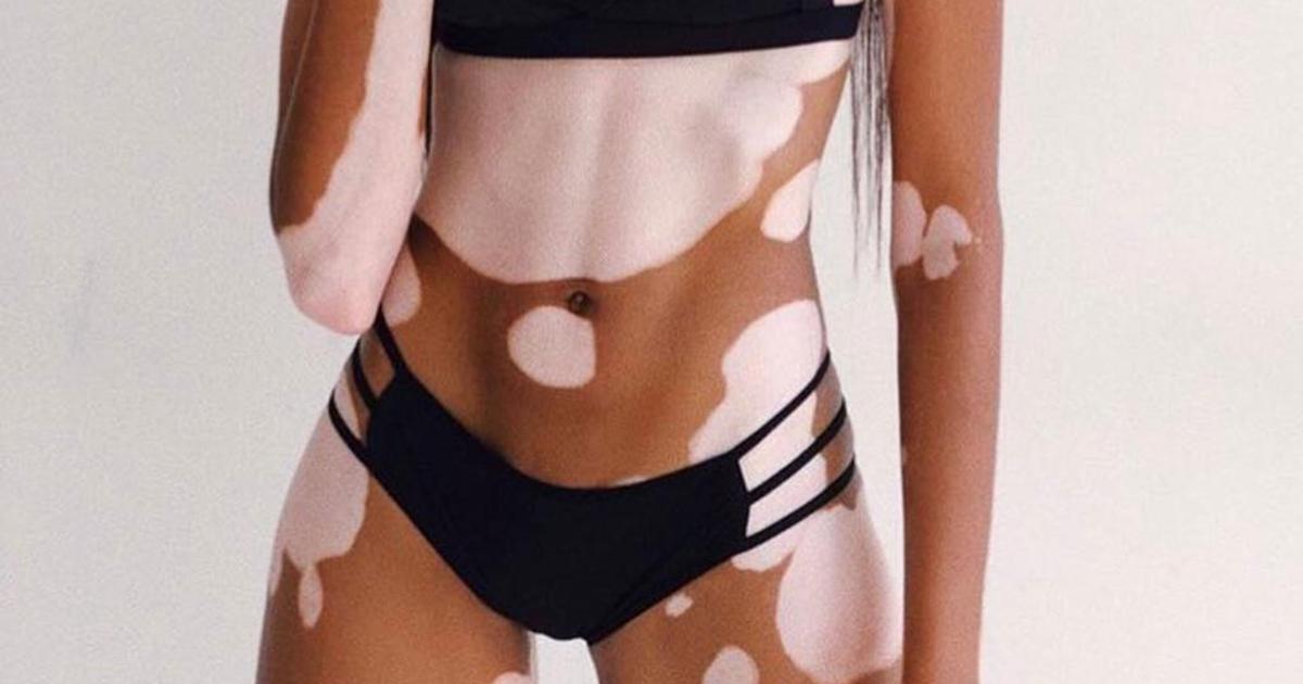 5 natural body defects people are self-conscious about | Pulse Nigeria