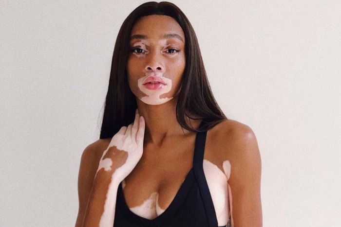 Canadian model has vitiligo [Vogue]