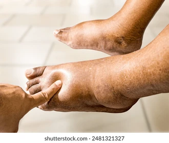 Feet swelling in older women [shuttershock]
