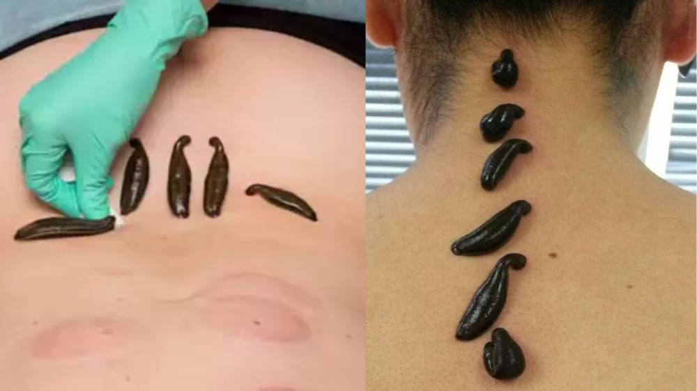 Leech therapy [SPPC]