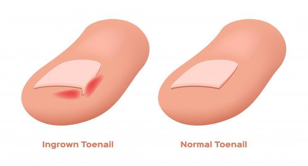 Ingrown nails can be super painful [MountainViewFoot]