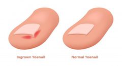 Ingrown nails can be super painful [MountainViewFoot]