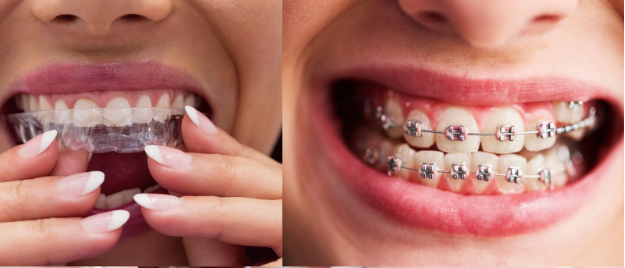 How Invisalign and other modern orthodontics are changing the game