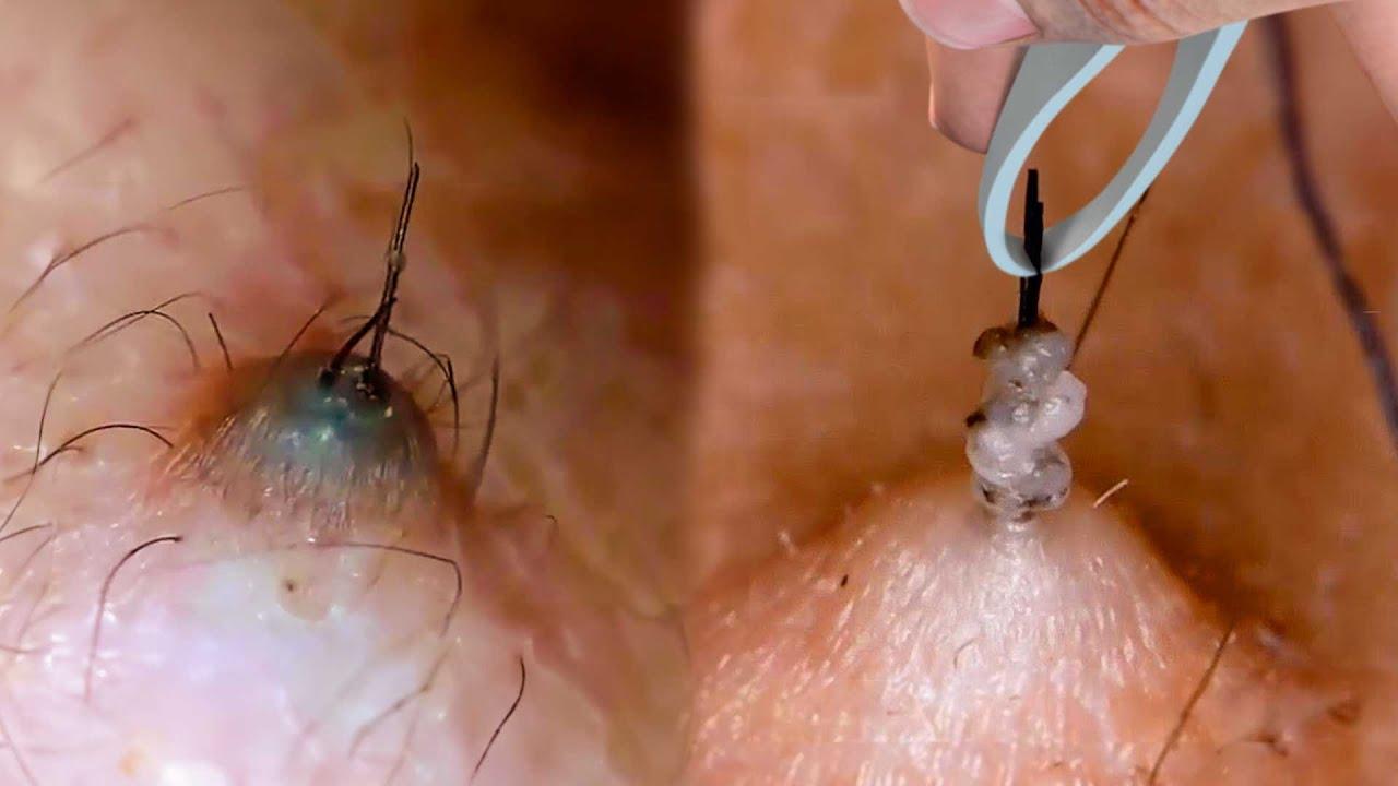 How to Get Rid of Ingrown Hair: 7 Safe and Effective Tips