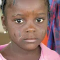 An image of an infected person with Buruli ulcer.