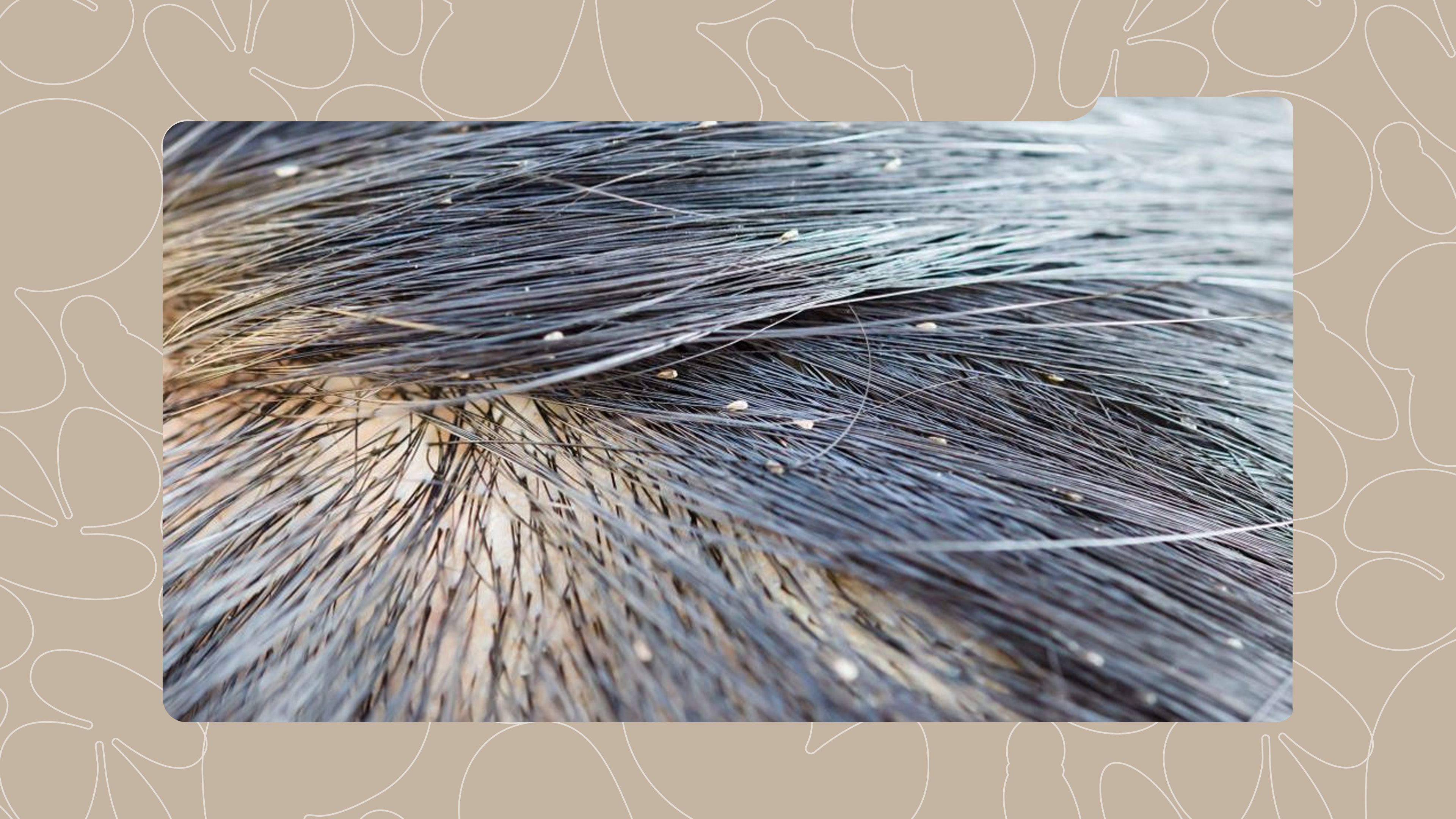How to Permanently Get Rid of Hair Lice