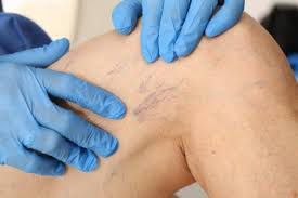 3 Natural remedies to get rid of web veins