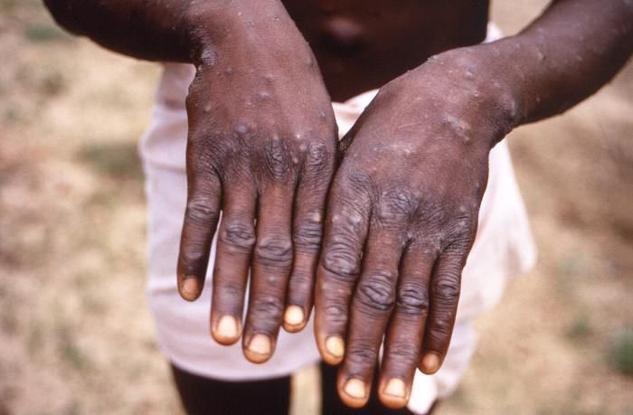 A case of monkeypox