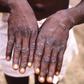A case of monkeypox