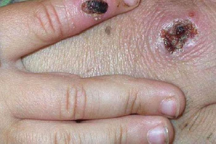 Monkeypox