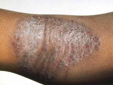 Eczema (Atopic dermatitis)