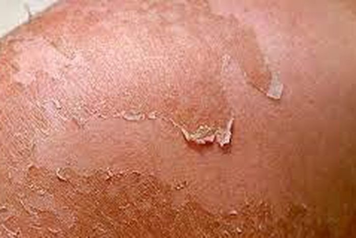 Peeling skin is not a good look [Insider]