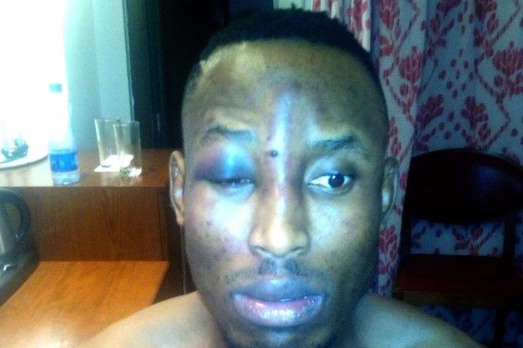 Mr 2Kay after the assault by robbers in his hotel room
