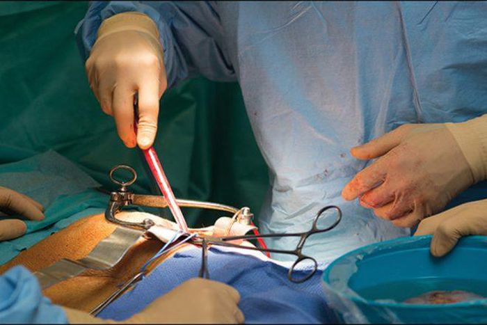 transplant (JournalDuCameroon)