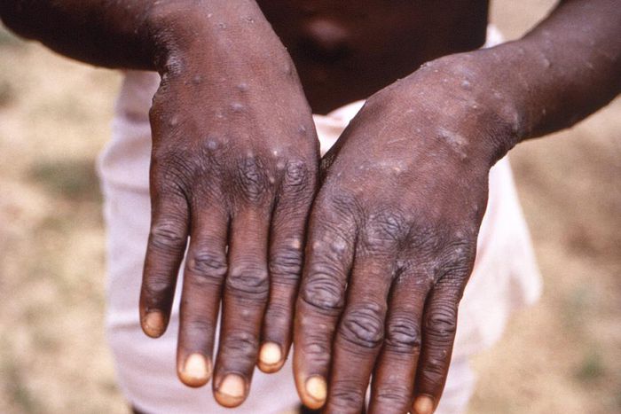 A person with monkeypox in the Democratic Republic of the Congo holds out their hands, which are covered in lesions.