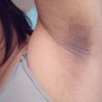 Dark underarm