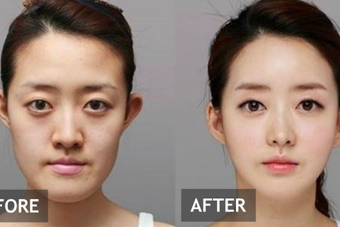 A South Korean lady before and after surgery [Koreaboo]