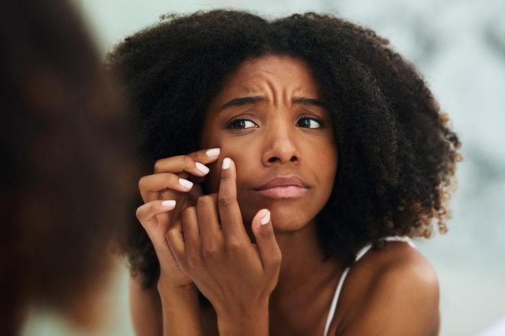 5 healthy home remedies of getting rid of acne scars and pimple marks