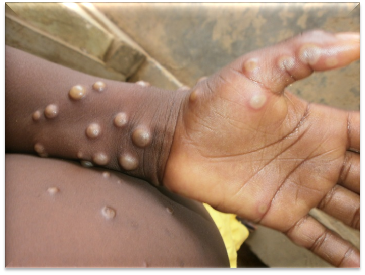 Monkey pox is a rare disease caused by monkeypox virus [WHO]