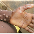 Monkey pox is a rare disease caused by monkeypox virus [WHO]