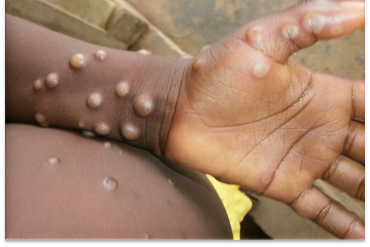 Monkey pox is a rare disease caused by monkeypox virus [WHO]