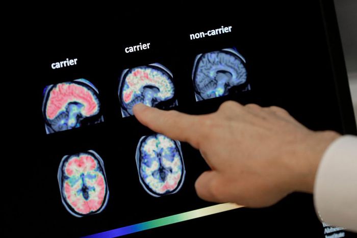 Dr. William Burke going over a PET brain scan at Banner Alzheimer's Institute in Phoenix. Biogen's drug was tested against carriers of the APOE gene, which is linked to Alzheimer's, and non-carriers.
