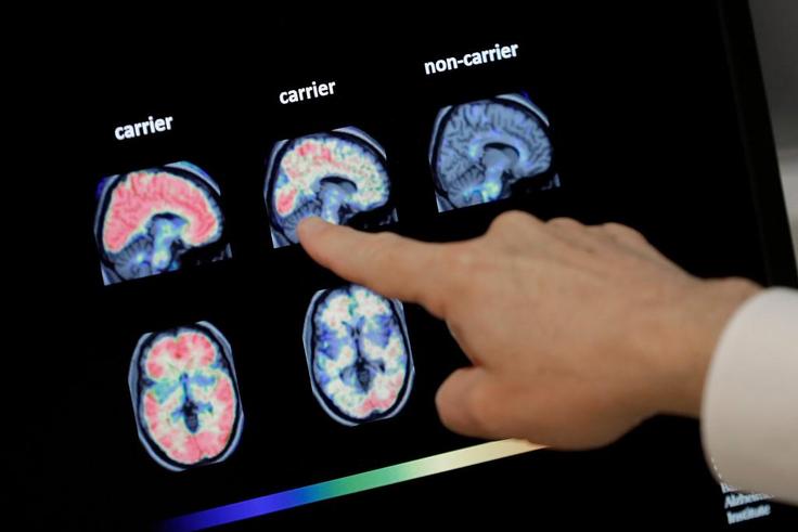 Dr. William Burke going over a PET brain scan at Banner Alzheimer's Institute in Phoenix. Biogen's drug was tested against carriers of the APOE gene, which is linked to Alzheimer's, and non-carriers.