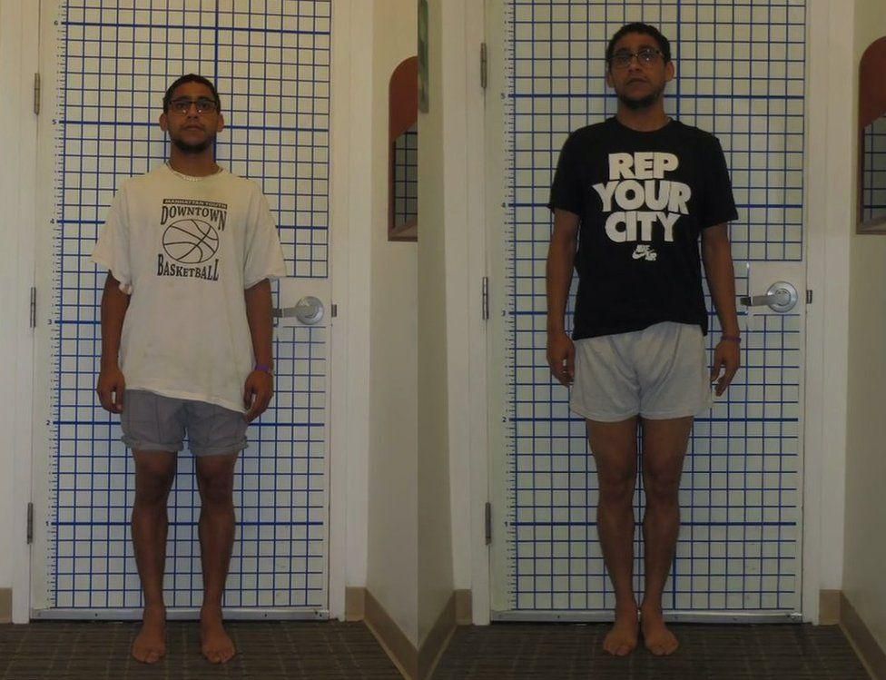 Leg lengthening is a trendy now [BBC]