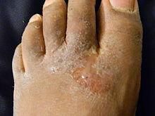 Athlete's Foot (Tinea Pedis)