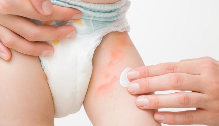 Diaper rash (irritant diaper dermatitis)