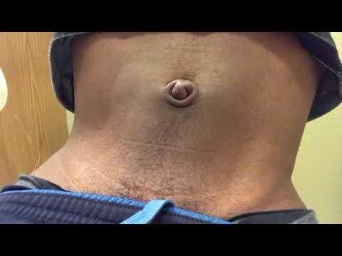 An outie belly button [WN]