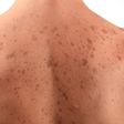 Dark spots on skin