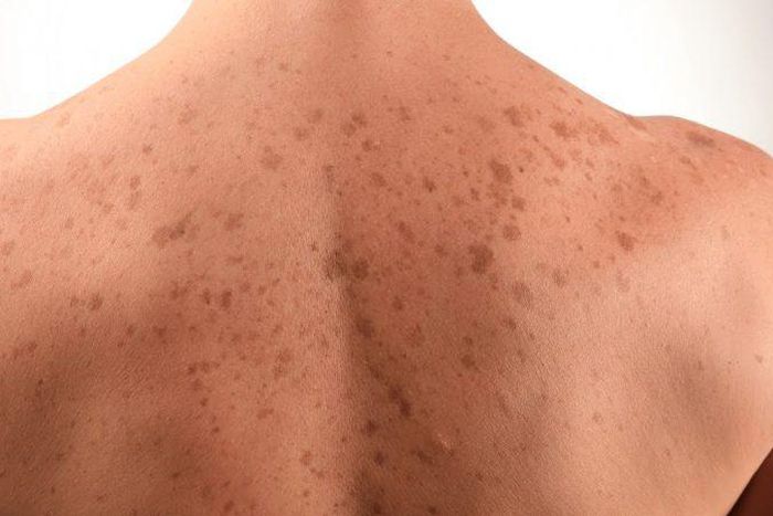 Dark spots on skin