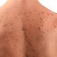 Dark spots on skin
