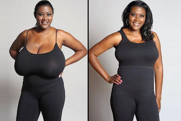 Breast reduction surgery is common these days [Rajat Gupta]