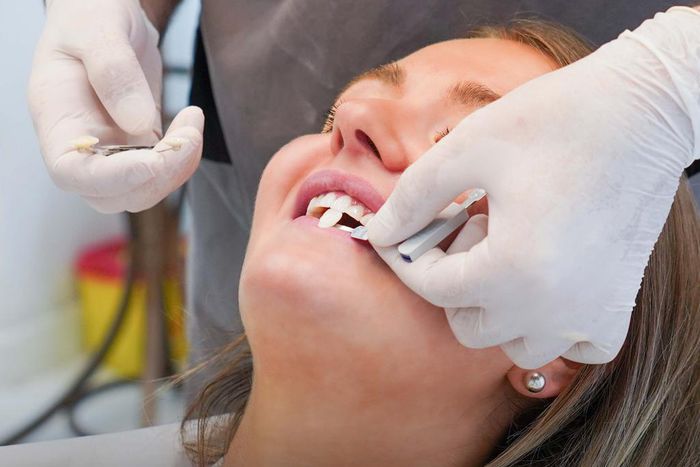 Porcelain teeth veneers cost