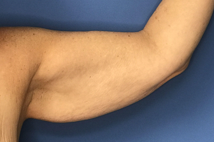 Flabby arms can be embarrassing [Drali]