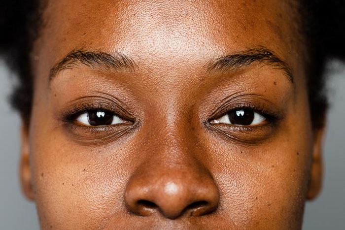 Sunburn causes hyperpigmentation [Healthline]
