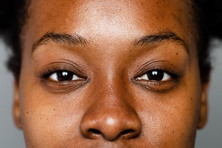 Sunburn causes hyperpigmentation [Healthline]