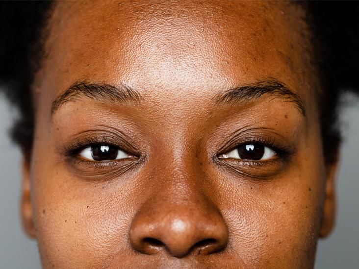Apply hydroquinone only on problem areas [Healthline]