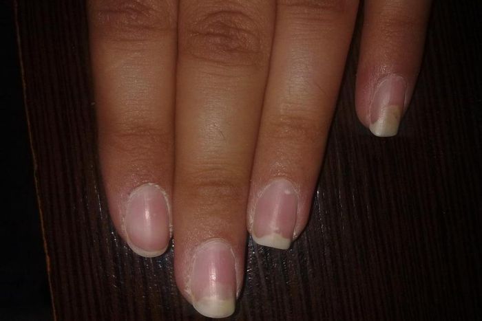 Causes and treatment of fingernails falling off