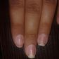Causes and treatment of fingernails falling off