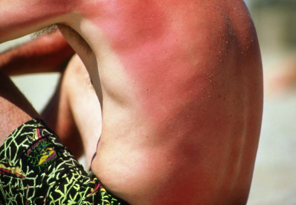 m3350071-mild-sunburn-consumer-science-photo-library-hi