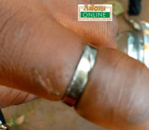 Evelyn Detordzi's finger