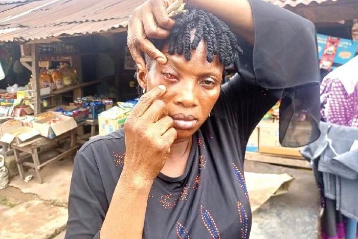 Woman accuse husband of blinding her eye after marrying second wife